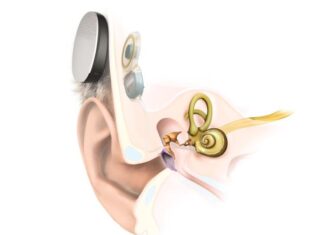 Recordaron el 60° aniversario del primer implante monoclear