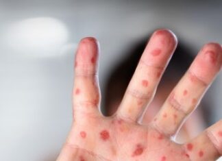 Viruela del mono: Confirmaron el primer caso del virus en el país