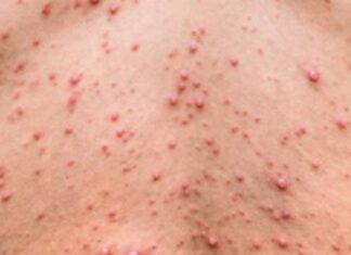 Salud confirmó el quinto caso de viruela símica en Argentina