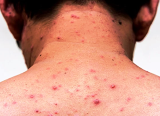 Confirmaron un caso de sarampión