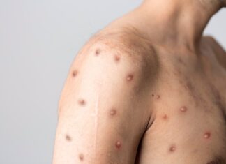 Entre Ríos se mantiene alerta a la situación epidemiológica de la viruela del mono