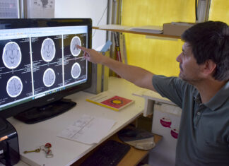 ACV: Cuáles son los signos de alerta y cómo actuar para reducir el daño cerebral
