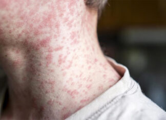 Alerta epidemiológica en Argentina por cuatro casos de sarampión detectados en viajeros