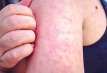 Sarampión: alertan a pasajeros que hayan viajado en un colectivo que pasó por Concepción del Uruguay