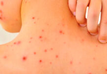 Salud Confirma Primer Caso de Sarampión en Entre Ríos y Activa Comisión de Vigilancia