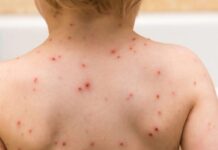 Temen un posible brote. Preocupación por caso de sarampión en Entre Ríos