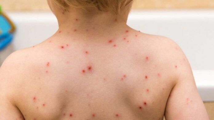 pagina 5 sociedad sarampion