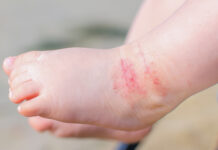 Cuidado de la piel infantil en verano: claves para prevenir afecciones