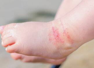 Cuidado de la piel infantil en verano: claves para prevenir afecciones