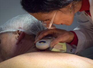 Advierten sobre la importancia de controlar lunares y lesiones para prevenir el cáncer de piel