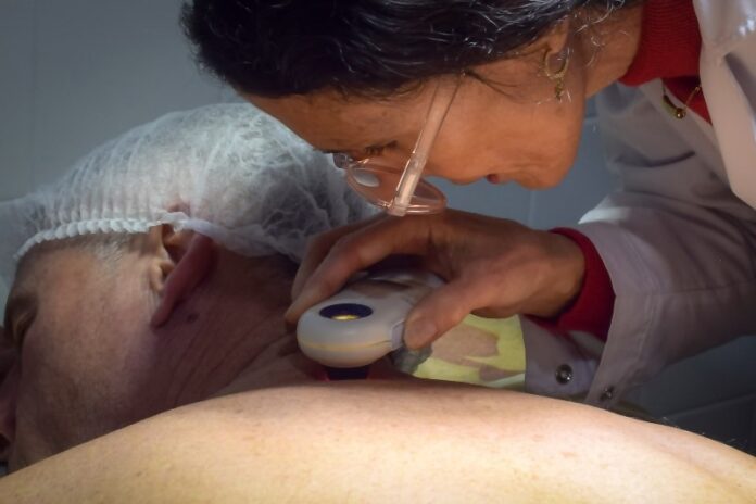 Salud promueve la consulta temprana de revisión de lesiones para prevenir el cáncer de piel