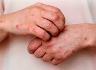 Confirmaron tres nuevos casos de Mpox y ya suman 11 en el país