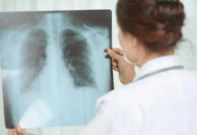 Entre Ríos registró un aumento del 38,8% en los casos de tuberculosis durante 2026