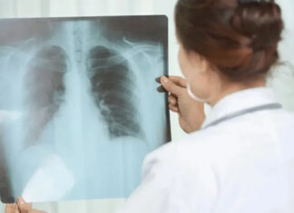 Entre Ríos registró un aumento del 38,8% en los casos de tuberculosis durante 2026