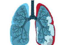 Fibrosis pulmonar: advierten sobre las demoras en el diagnóstico y la importancia de la detección temprana